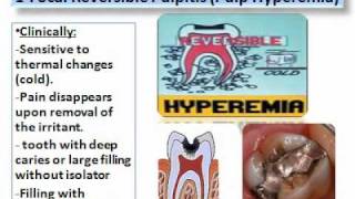 Pulp Diseases Oral Pathologywmv [upl. by Grieve253]