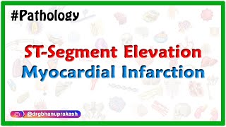 Complications of STsegment elevation myocardial infarction STEMI [upl. by Combes976]