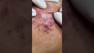 Inflamed Acne and Blackhead Removal CloseUp Secrets to Clear and Smooth Skin [upl. by Akcebar160]