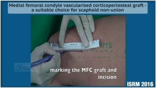 Medial femoral condyle vascularised corticoperiosteal graft [upl. by Smaoht355]