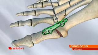 Wright  Ortholoc 3DI MTP Fusion NEW [upl. by Ecinue]