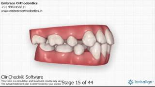 Extraction space closure with Invisalign India [upl. by Ennyroc]