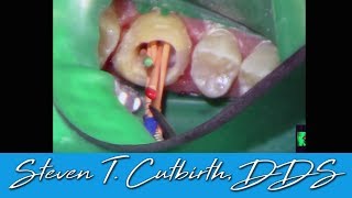 Endo of 5 Canal Molar  Dental Minute with Steven T Cutbirth DDS [upl. by Ydassac729]