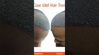 haircare hairlossttreatment besthairtransplantresults hairtransplantclinic hairtransplant [upl. by Melessa]