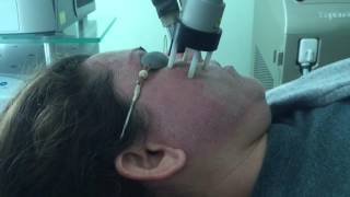 Exelo CO2 Laser Fraccionado  Dermalaser Clinic Dr agapito Cepeda Reynosa Tamp Mexico [upl. by Amsaj]