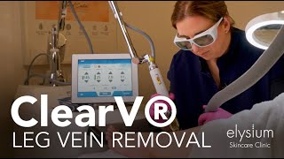 ClearV® Laser for Leg Vein Removal [upl. by Esile]