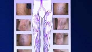 Venous Insufficiency Animation [upl. by Nyrahs440]