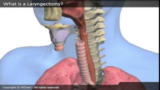 A0001a en A patient´s Guide to Total Laryngectomy Part 1 What is a Laryngectomy [upl. by Nyrb]