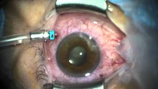 Diathermy to Seal Leaking Sclerotomies in SmallGauge Vitrectomy [upl. by Gerg553]