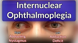 Internuclear Ophthalmoplegia  Left INO Case example explained [upl. by Nord]