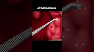 ASMR Tonsil Treatment and Stone Removal Animation Bad Breath Part 3 [upl. by Carney]