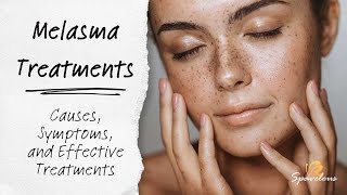 Spavelous Talks Melasma Treatments  Causes Symptoms and Effective Treatments for Melasma [upl. by Olenolin735]