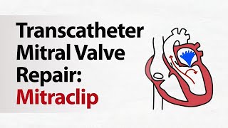 Transcatheter Mitral Valve Repair Mitraclip [upl. by Ashlee]