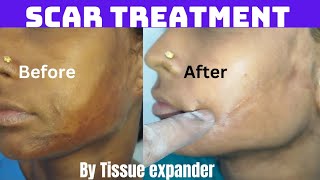 Scar correction with tissue expander Treatment of scar using tissue expander  Result after 4 month [upl. by Eceertal656]