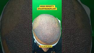 Hair Loss Treatment hair hairloss hairlosstreatment ytshorts alopecia hairtransplant hairfall [upl. by Mulac]