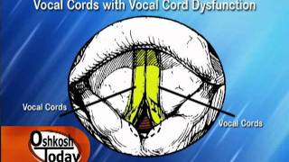 Vocal Cord Dysfunction [upl. by Ives]