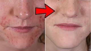 HOW TO CURE PERIORAL DERMATITIS NATURALLY AT HOME [upl. by Bradly]