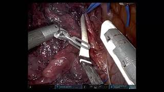 Roboticassisted right upper lobecomy with en bloc chest wall resection [upl. by Sirois]