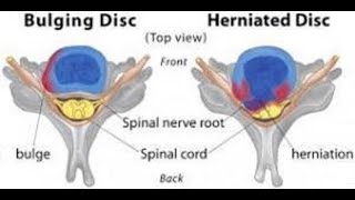 Disc Herniation vs Disc Bulge [upl. by Fawn413]