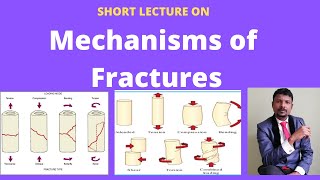 FRACTURE MECHANISM DIRECT INDIRECT INJURYCAUSES FATIGUE OR STRESS FRACTUREPATHOLOGICAL FRACTURE [upl. by Milde]