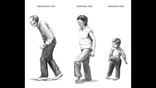 Waddling Gait Myopathic Gait  Definition Causes characteristics Disease association Diagnosis [upl. by Rein114]