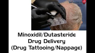 Dr Wambier demonstrates Drug Delivery of Minoxidil and Dutasteride Tattooing to the Scalp [upl. by Ylahtan415]