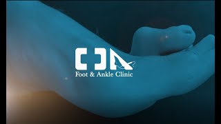 Minimally Invasive Rigid Hammertoe Surgery [upl. by Eniarrol811]