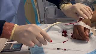 Distal Radial Artery Cannulation [upl. by Eniowtna938]