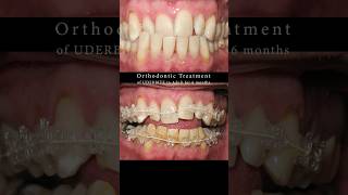 Underbite in Adults  six months treatment smile timelapse BRACES [upl. by Noli250]