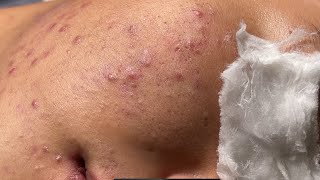 Blackheads amp Whiteheads Pore Removal New 2024  Acne Treatment With Bo Nguyễn Spa [upl. by Gnilsia]