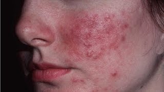 Home Remedies for rosacea  Red Face  How to get rid of Rosacea [upl. by Amanda]