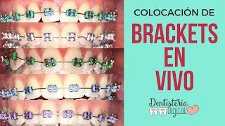 COLOCACIÓN DE BRACKETS EN VIVO  Putting on Braces  LIVE [upl. by Leicester704]