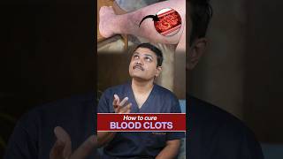 How to Treat Blood Clots Insights from vascularsurgeon shortvideo [upl. by Mastat]