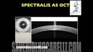 Assessment of Central Corneal Thickness In Healty Eyes Using Anterior Segment OCT [upl. by Llerret907]