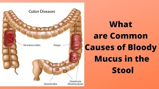 What are Common Causes of Bloody Mucus in the Stool [upl. by Heuser]