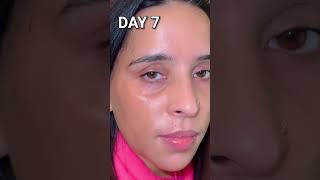 Cosmelan treatment DAY 1 to 7  Dr Pooja Kasana [upl. by Wystand]