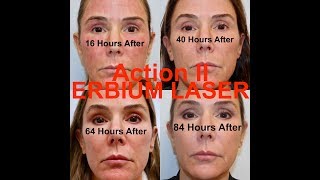 Action II Erbium Laser Resurfacing  Stepbystep procedure start to finish with Dr Weiner [upl. by Akerue]