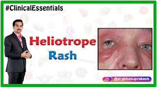 Heliotrope rash in Dermatomyositis  Clinical Essentials [upl. by Adamsen]