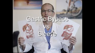 Gastric Bypass vs Sleeve update for 2021 [upl. by Anialed]