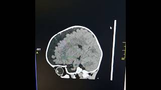 Agenesis of corpus callosum  External hydrocephalus [upl. by Gibbons]