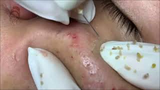 Relax Every Day acne pimplepopping blackheads [upl. by Nore485]