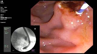 ERCP  Distal CBDCCA cytology and intraductal biopsy of stricture stenting [upl. by Ayekal]