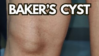 Bakers Cyst Explained What You MUST Know About Knee Pain Relief [upl. by Kcoj]