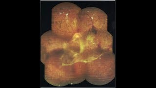 Vitreous Adhesions Diagnosis amp Treatment [upl. by Hector33]