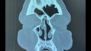 Bilateral endoscopic sinus surgery for sinusitis with polyposis [upl. by Airdnal202]