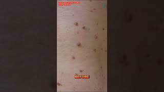 Skin Tag Removal by Laser [upl. by Mccafferty]