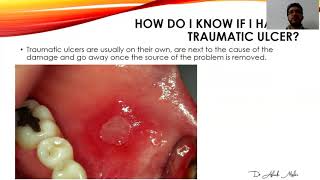 MOUTH ULCERS [upl. by Ahcim152]