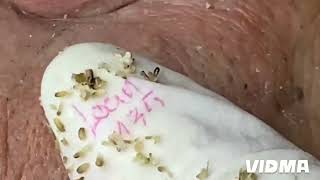 It feels so good to remove Blackheads and Whiteheads [upl. by Eidak]