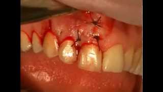 LIVE OPERATION Gingiva stiching [upl. by Paresh]