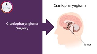 Endoscopic craniopharyngioma surgery [upl. by Hattie]